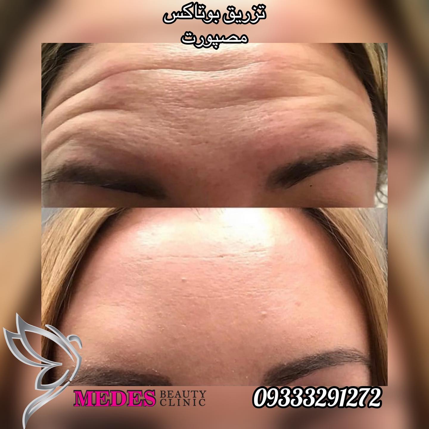 گالری تزریق بوتاکس